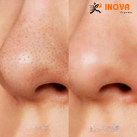 [COMPRE 1 LEVE 2] LANBÉNA - Removedor de Cravos hidratante de forma suave, natural e profunda + 60 Brindes