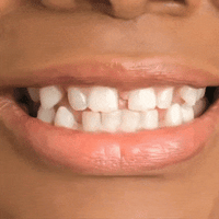 Kit de Prótese Dental Superior e Inferior – Smile Pro – Dentes Brancos Sem Cirurgia
